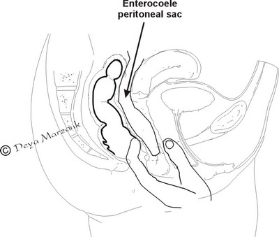 enterocoele